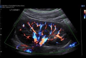 Renal Ultrasound